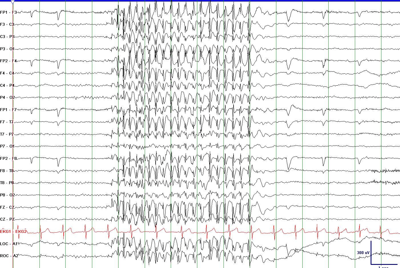 EEG 3 To 6 1