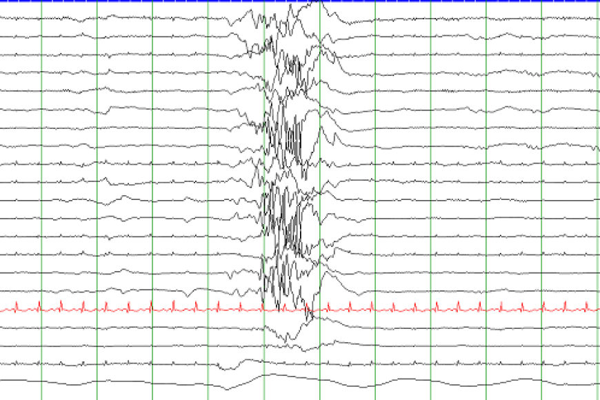 abnormal EEG