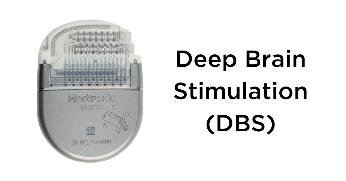 Deep Brain Stimulation for Seizures | Epilepsy Foundation